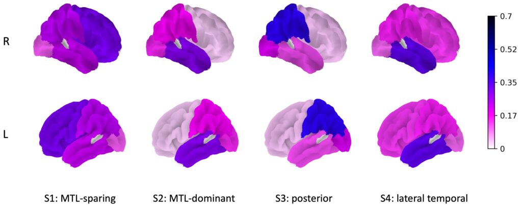 Genomics- and image-guided subtyping guide the characterization of Alzheimer's disease