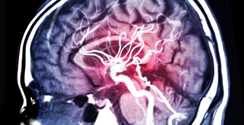 MRI Scan in Brain Hemorrhage