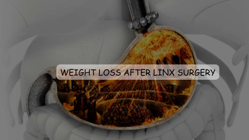 Explore Changes in Weight Loss After Linx Surgery Featured Images