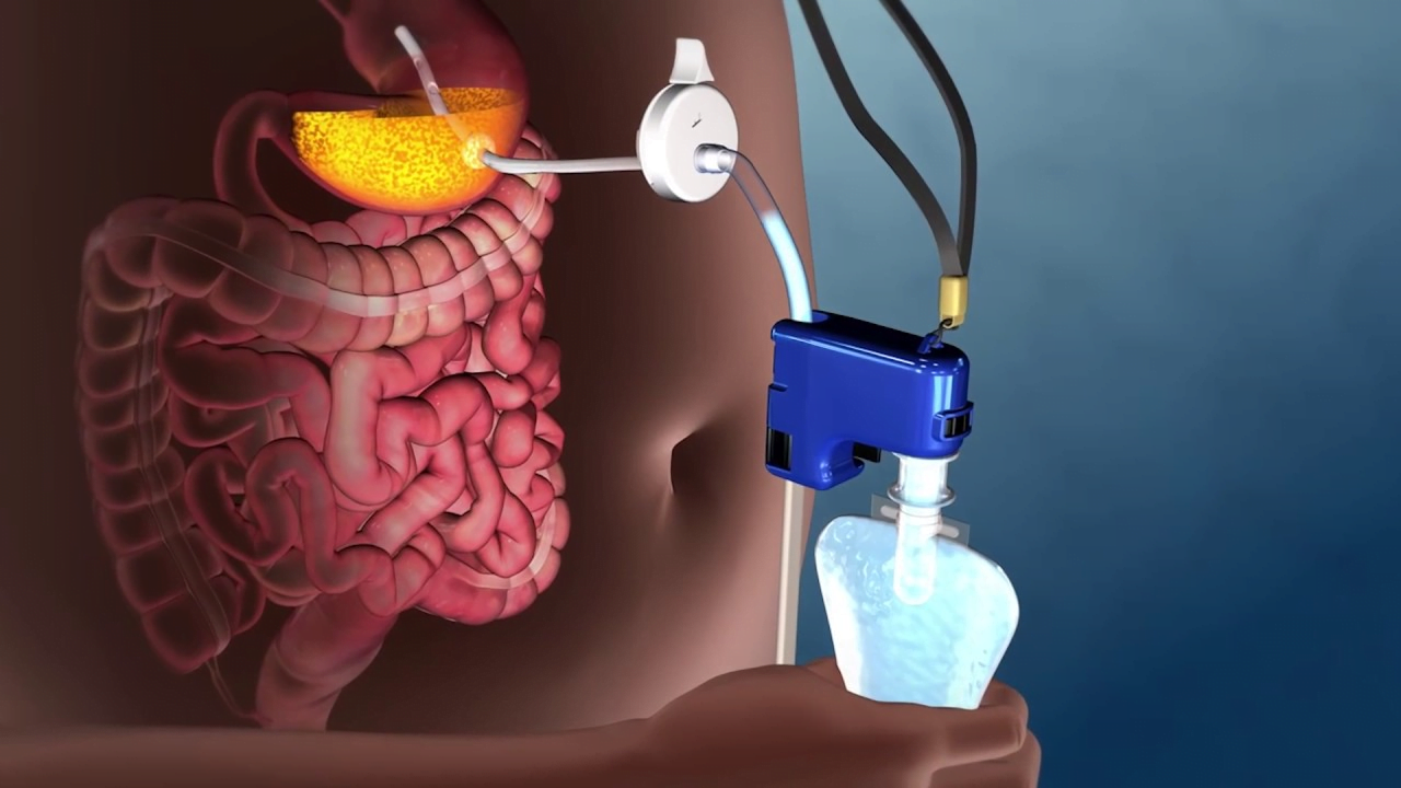 Gastric Aspiration Therapy