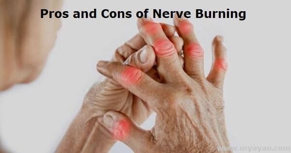 Pros and Conic of Nerve Burning Featured Images